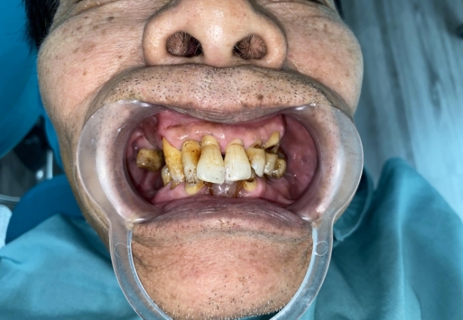 Mòn cổ răng – bệnh lý nha khoa phổ biến nhưng dễ bị bỏ qua.