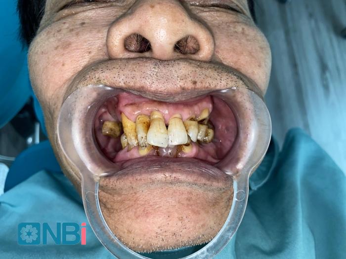 Bệnh nhân mòn cổ răng tới khám tại nha khoa NBi