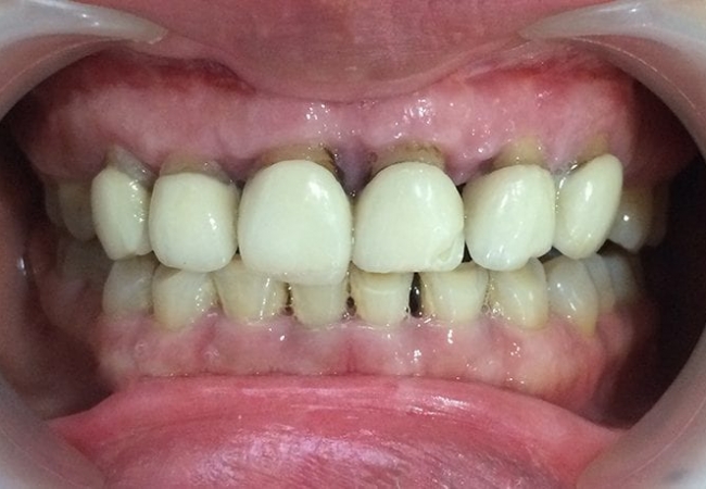 Bọc răng sứ, đừng ham rẻ – Lời khuyên từ chuyên gia