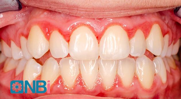 Bọc răng sứ kém chất lượng dẫn đến viêm lợi, hôi miệng, đau nhức...