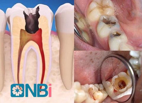 Sâu răng dẫn tới tình trạng viêm tủy.