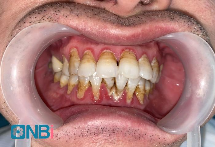 Khách hàng bị viêm lợi, tụt lợi do để cao răng mảng bám quá nhiều.