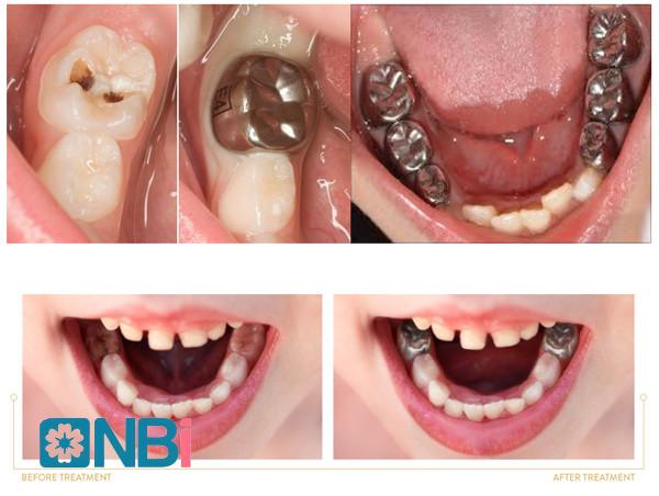 Trước và sau chụp thép răng sứ.