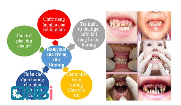 Những tác hại khi răng sữa của trẻ bị tổn thương.