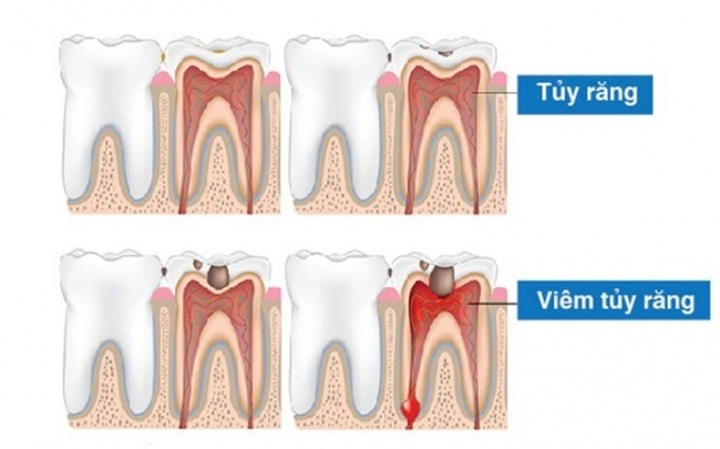 Viêm tủy răng: Khi nào cần điều trị?